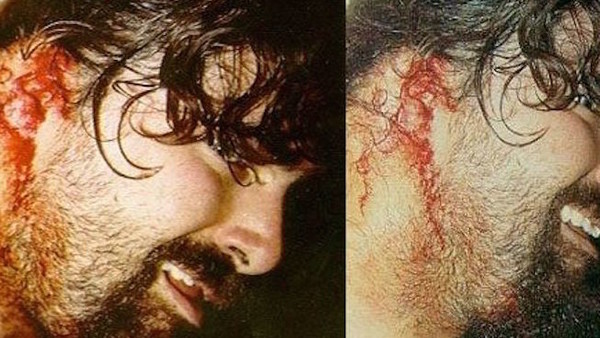 Triple H Injury