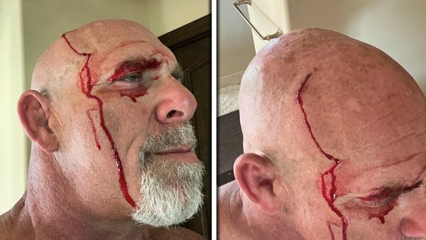 Goldberg injuries